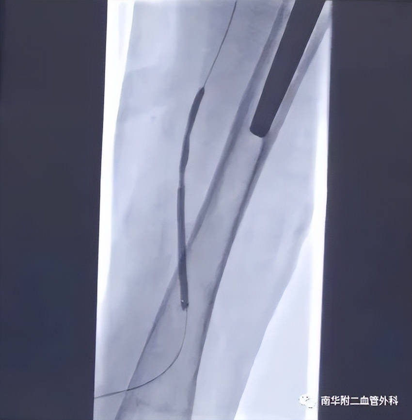 下肢血管闭塞介入治疗视频,动脉血管狭窄的最新介入治疗方法