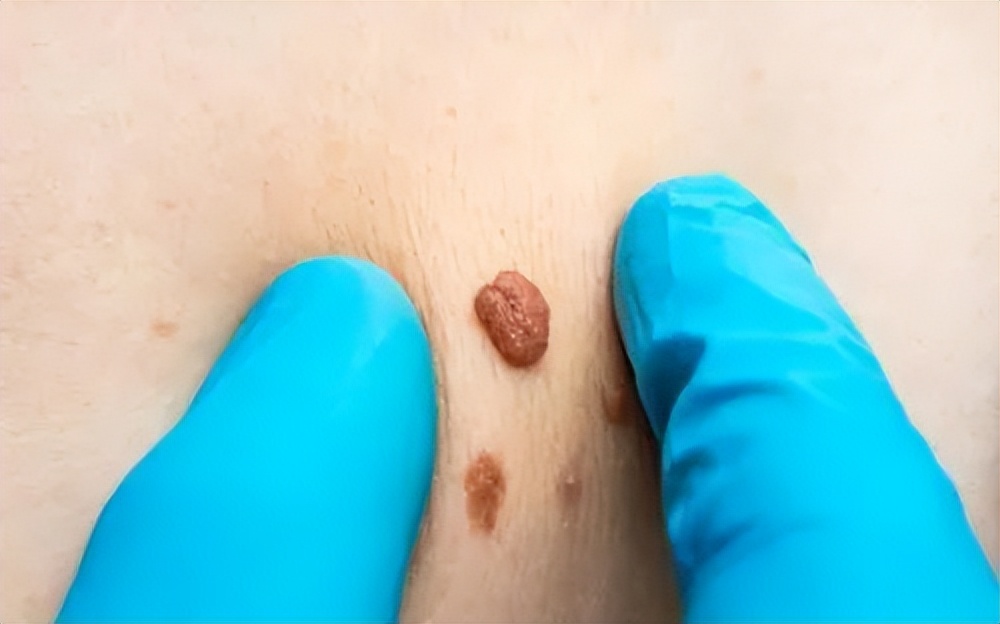 痣提前弄掉会导致黑色素瘤吗,痣和黑色素瘤哪个可以抠掉