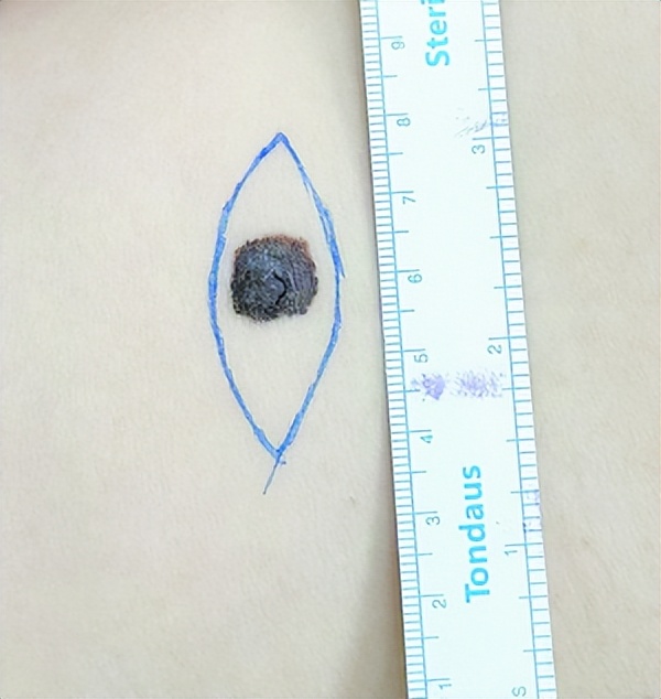 点痣和本身的痣有区别吗,有痣一定及时去医院