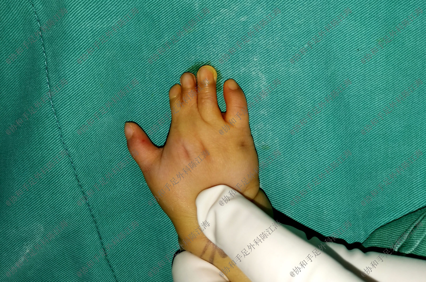 儿童做了植皮长大还需要植皮吗,小孩植皮后长大后还需要植皮吗