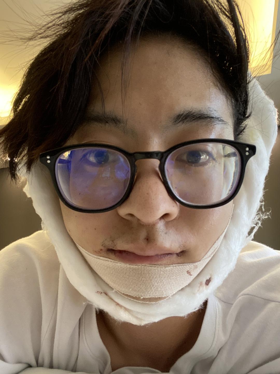 日本1米5小哥砸1600万疯狂整容增高！断骨惨烈过程吓傻网友