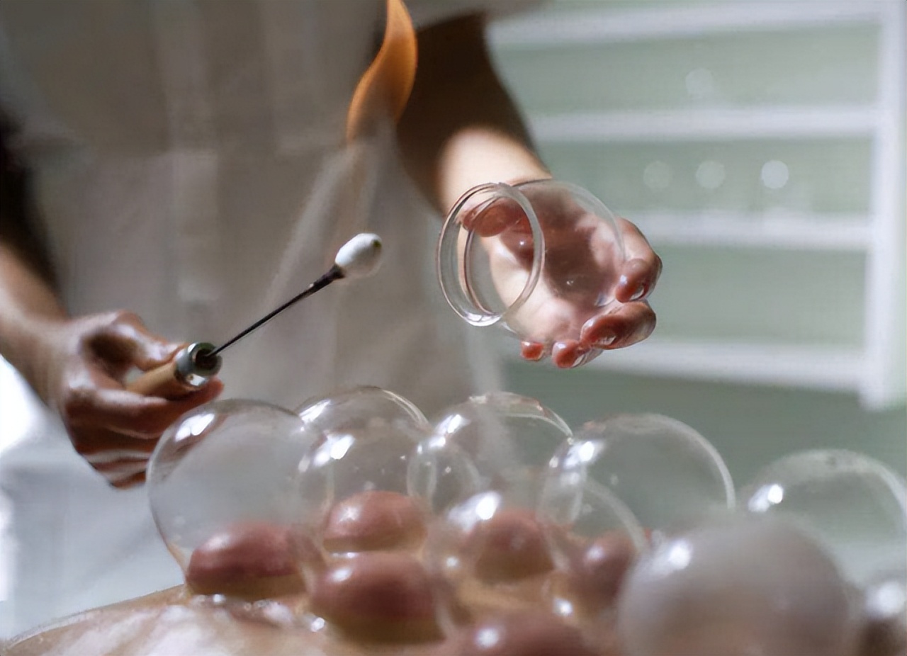 拔火罐吸出来的是湿气还是毒素,拔火罐吸出来的淤血是什么