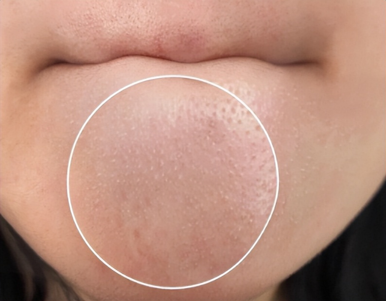 去黑头粉刺去闭口的护肤品,黑头闭口粉刺应该如何清理