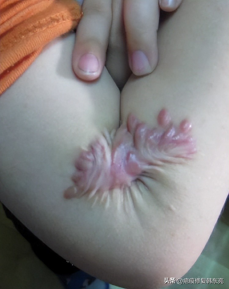 疤痕封闭治疗危害,关节处疤痕治疗