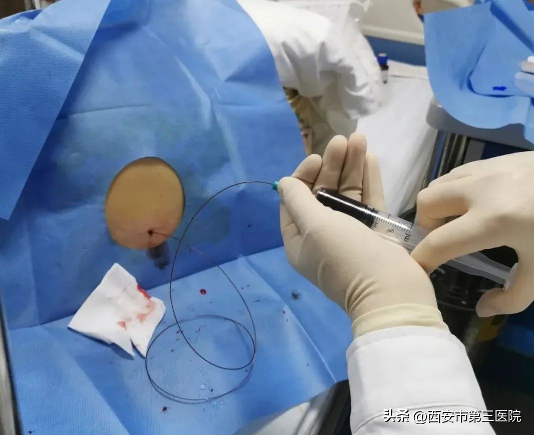 低颅压性头痛应怎样治疗,低颅压性头痛是怎么治疗