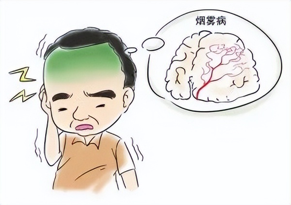 检查烟雾病脑子里有异常信号,左侧大脑烟雾病