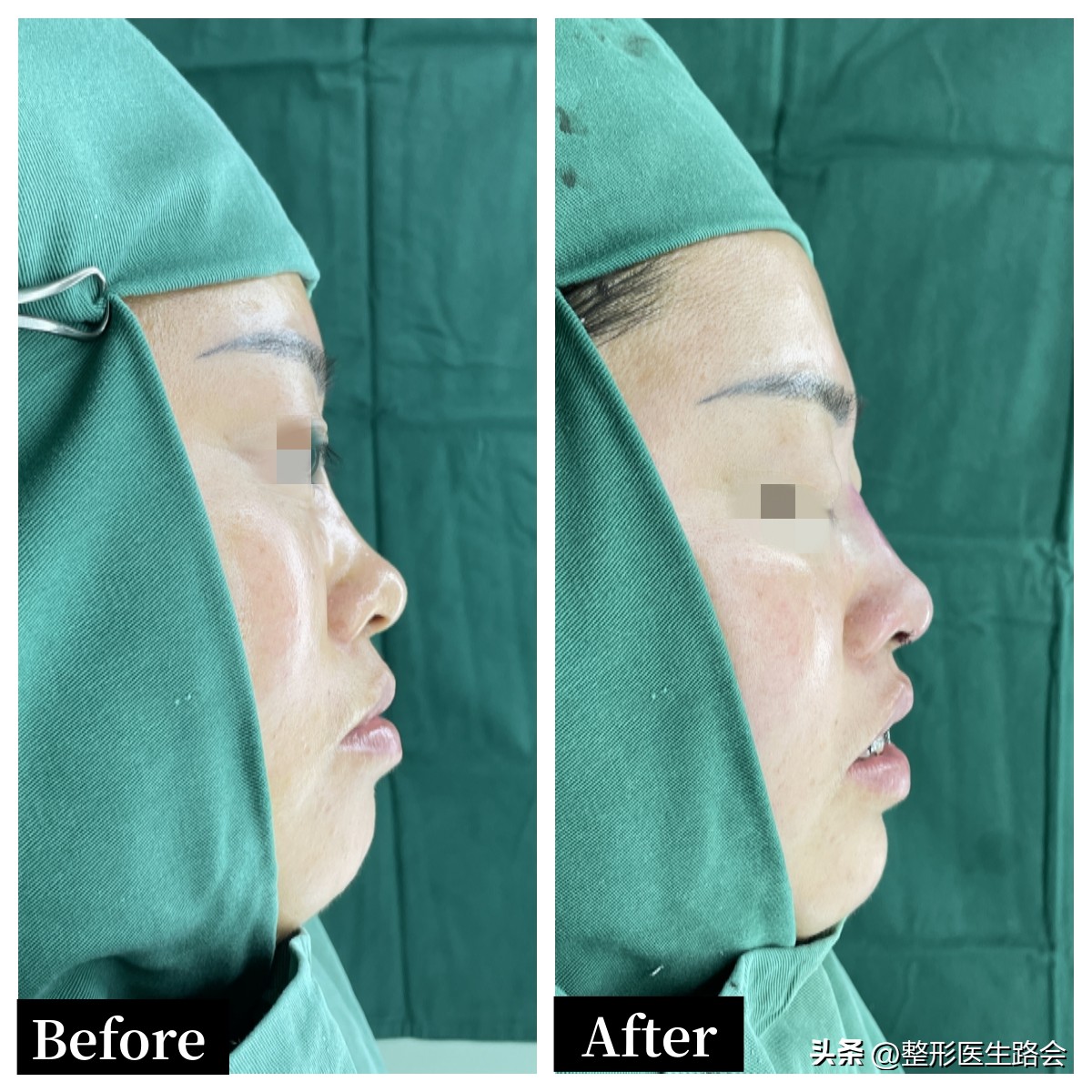 线雕鼻修复成超肋隆鼻,线雕隆鼻能解决鼻基底凹陷吗