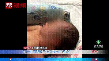 婴儿出生囊肿,宝宝出生颈部淋巴囊肿