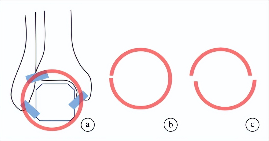 踝关节腓骨下端骨折怎么治疗,胫腓骨下端骨折踝关节康复的目标