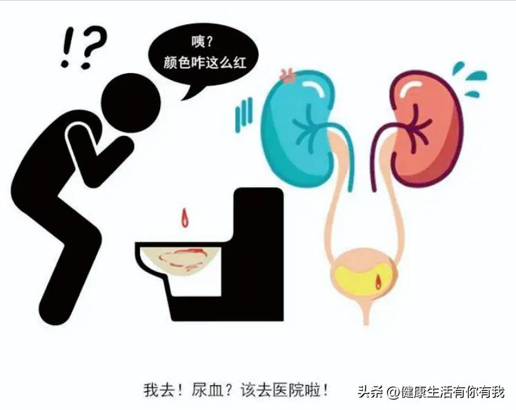 什么是血尿和尿潜血,什么是血尿是怎么回事