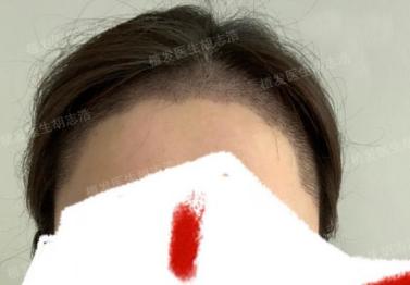 植发后后枕部的头发多久能恢复,植发手术后3个月恢复过程