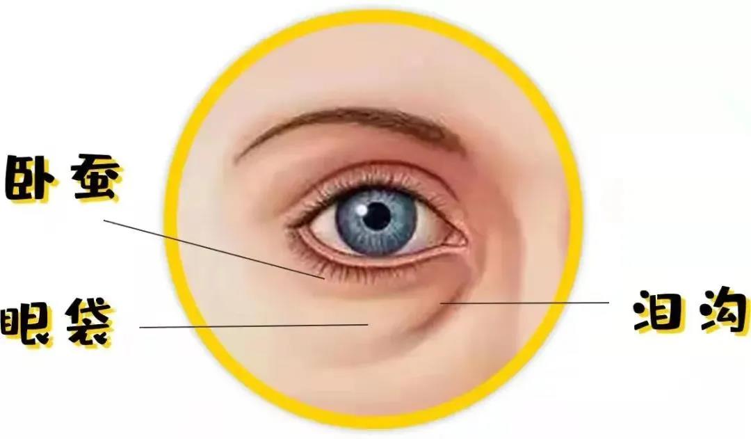 一分钟教你鉴别泪沟卧蚕和眼袋,卧蚕眼袋泪沟是手术好还是填充好