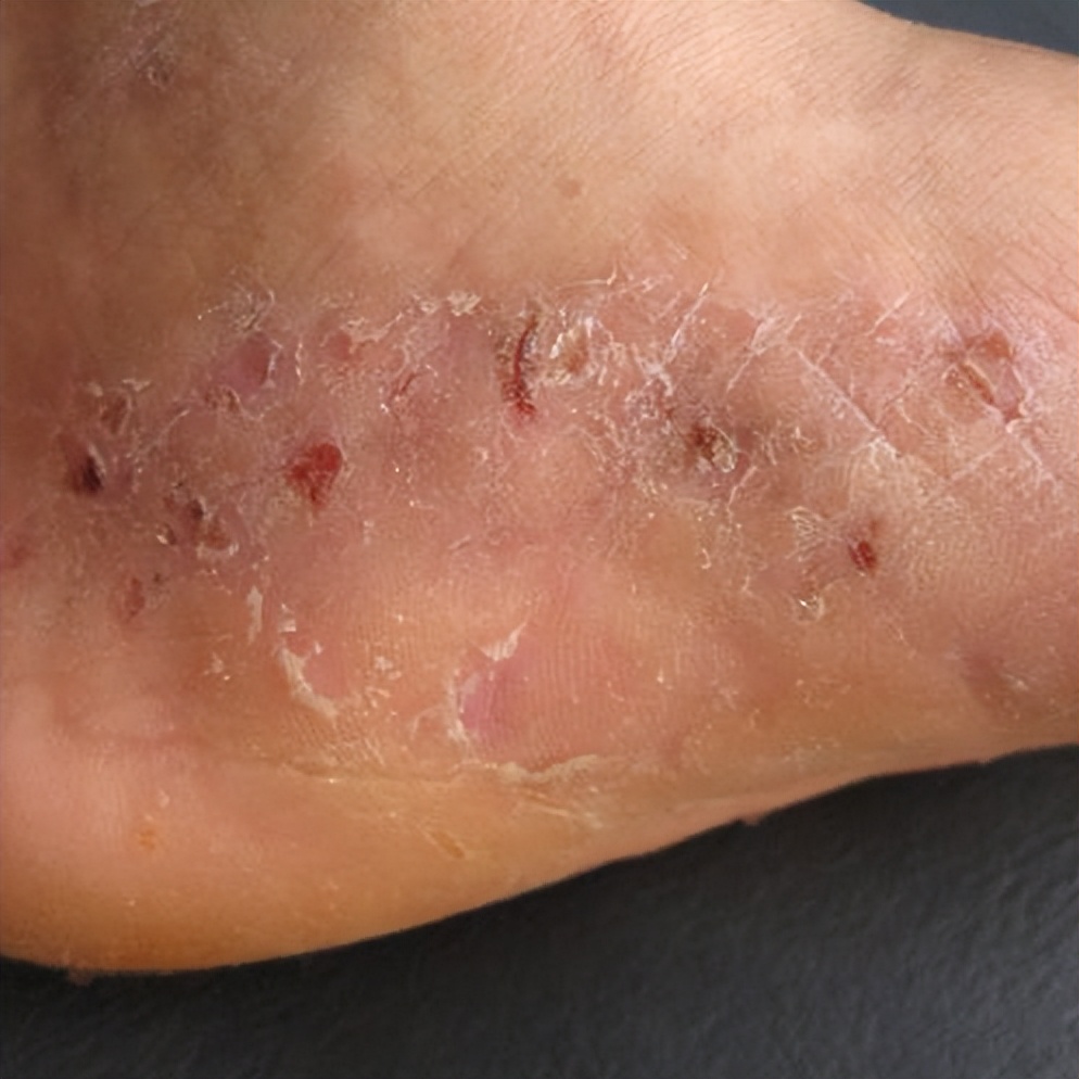 去完水上乐园怎么防止得妇科病,水上乐园妇科病