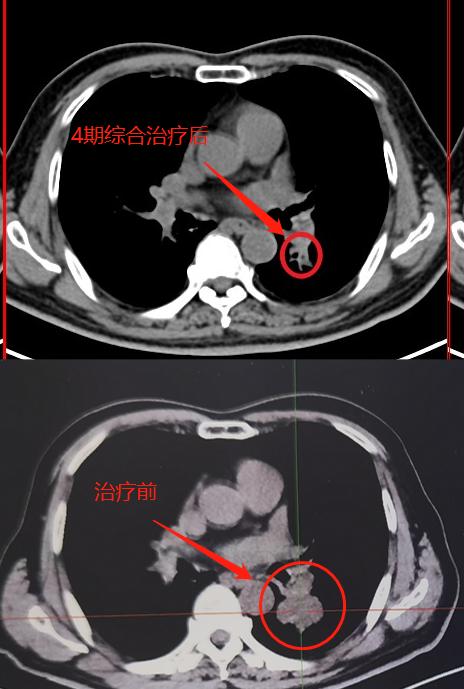 PET/CT病例（6）：4.0cm肺癌治疗后缩小到1cm，来看看治疗方案
