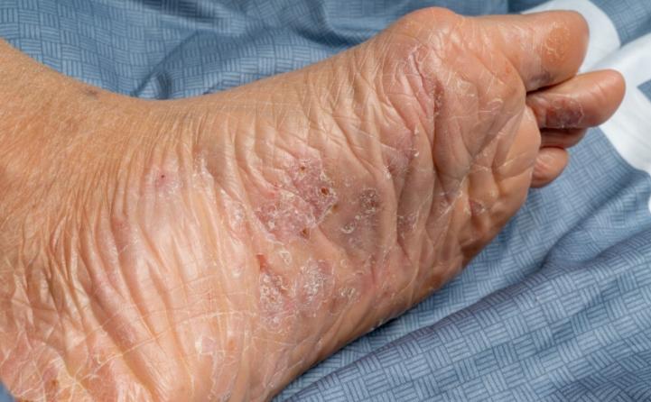 日本人如何处理脚气问题,欧美人为什么更容易患脚气