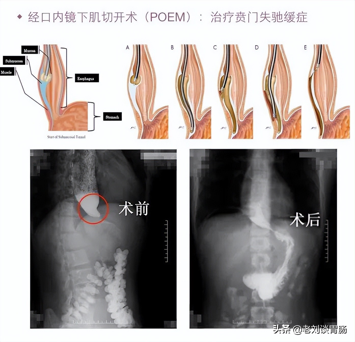 贲门失弛缓症什么引起的,贲门失弛缓症是什么原因引起的