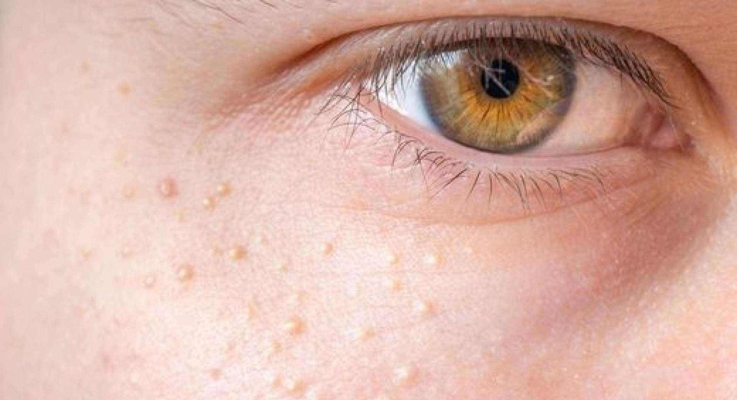 脖子和腋下的小肉粒是什么,脖子和腋下长小肉刺会自己脱落吗