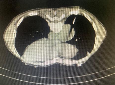 介入穿刺全过程,介入穿刺技术