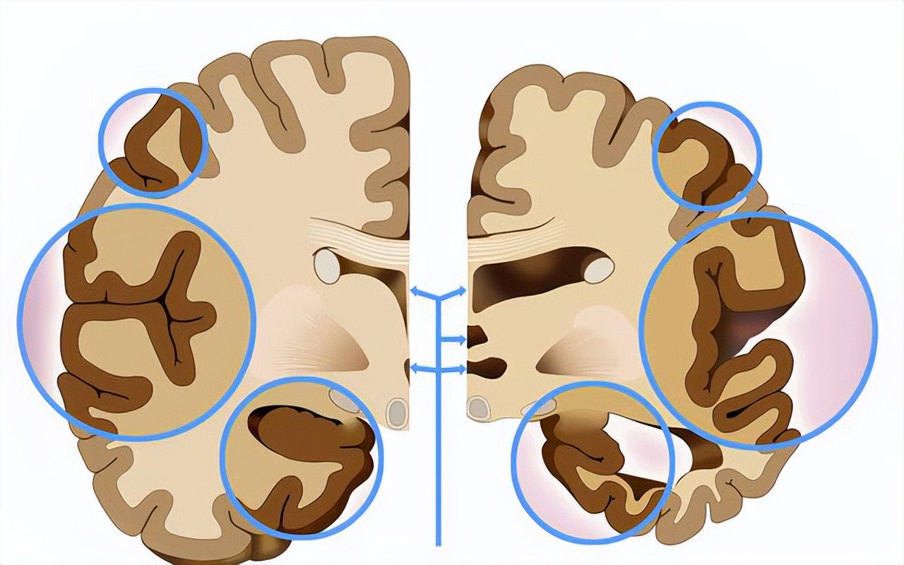 脑萎缩不可轻视应尽早防治,岁数大了脑萎缩吃什么药