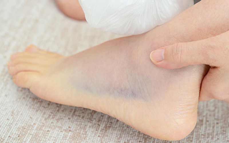 崴脚怎么判断是不是彻底好了,崴脚的五大误区及正确处理方式