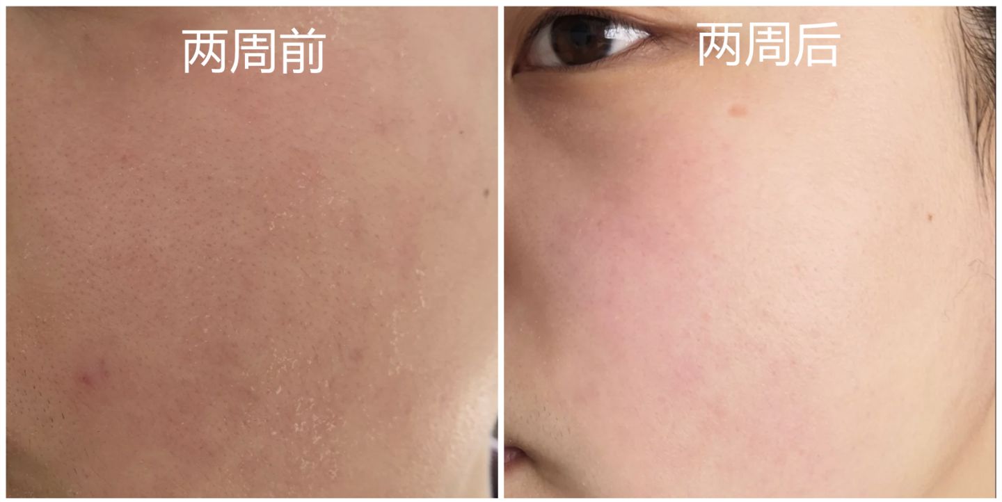 每到秋天，手和腿上就会出现各种干燥情况，还会脱皮，要怎么办？