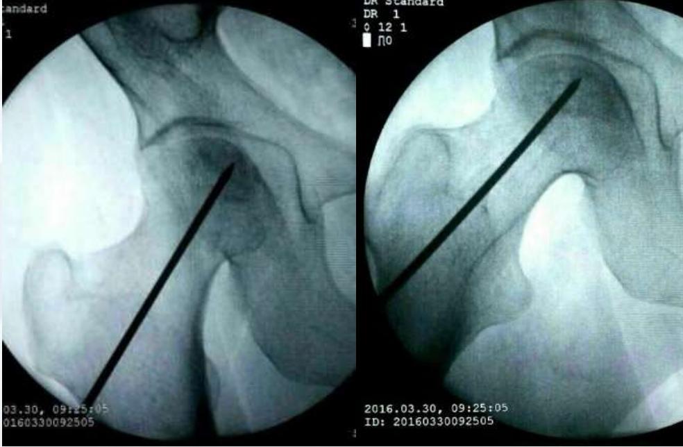 股骨头坏死保髋微创手术成功率,髋部骨头坏死微创手术康复训练