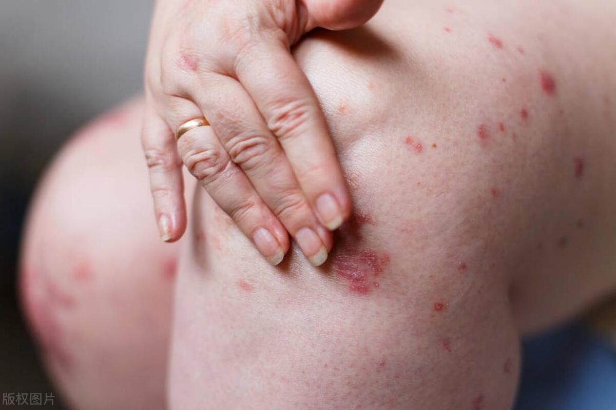 牛皮癣喝中药停用多久可以备孕,牛皮癣患者备孕吃药