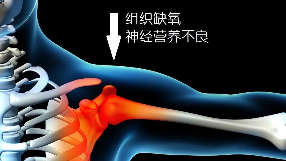 肩膀疼痛要警惕的三种病肩周炎,肩周炎是什么原因造成的肩膀痛
