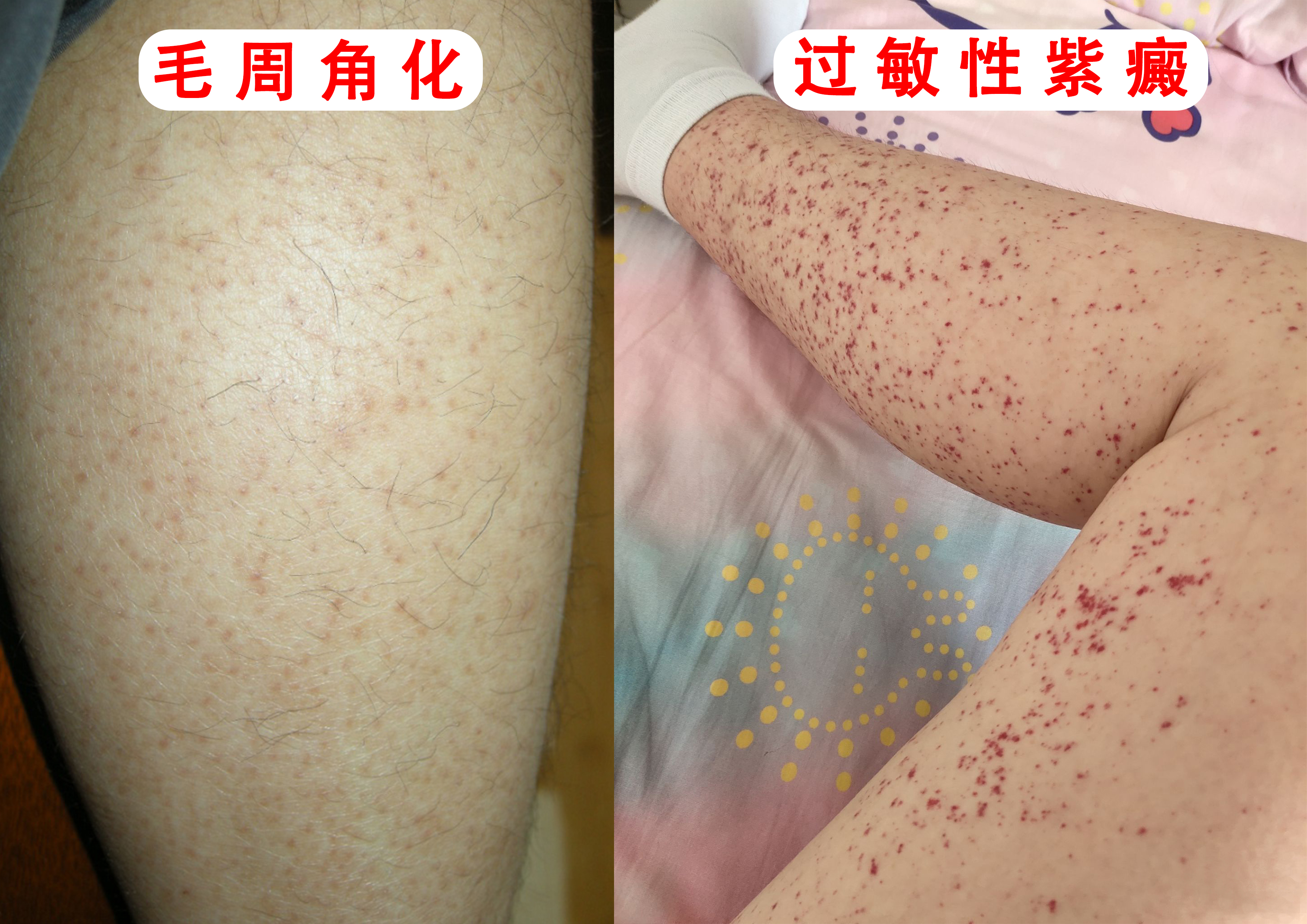 过敏性紫癜属于皮肤病吗,和过敏性紫癜相似的皮肤病