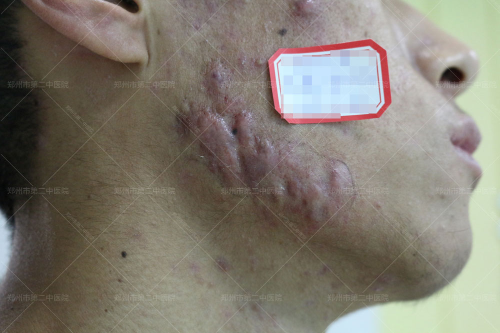 中医怎样治疗增生性疤痕疙瘩,长沙疤痕疙瘩去哪里治