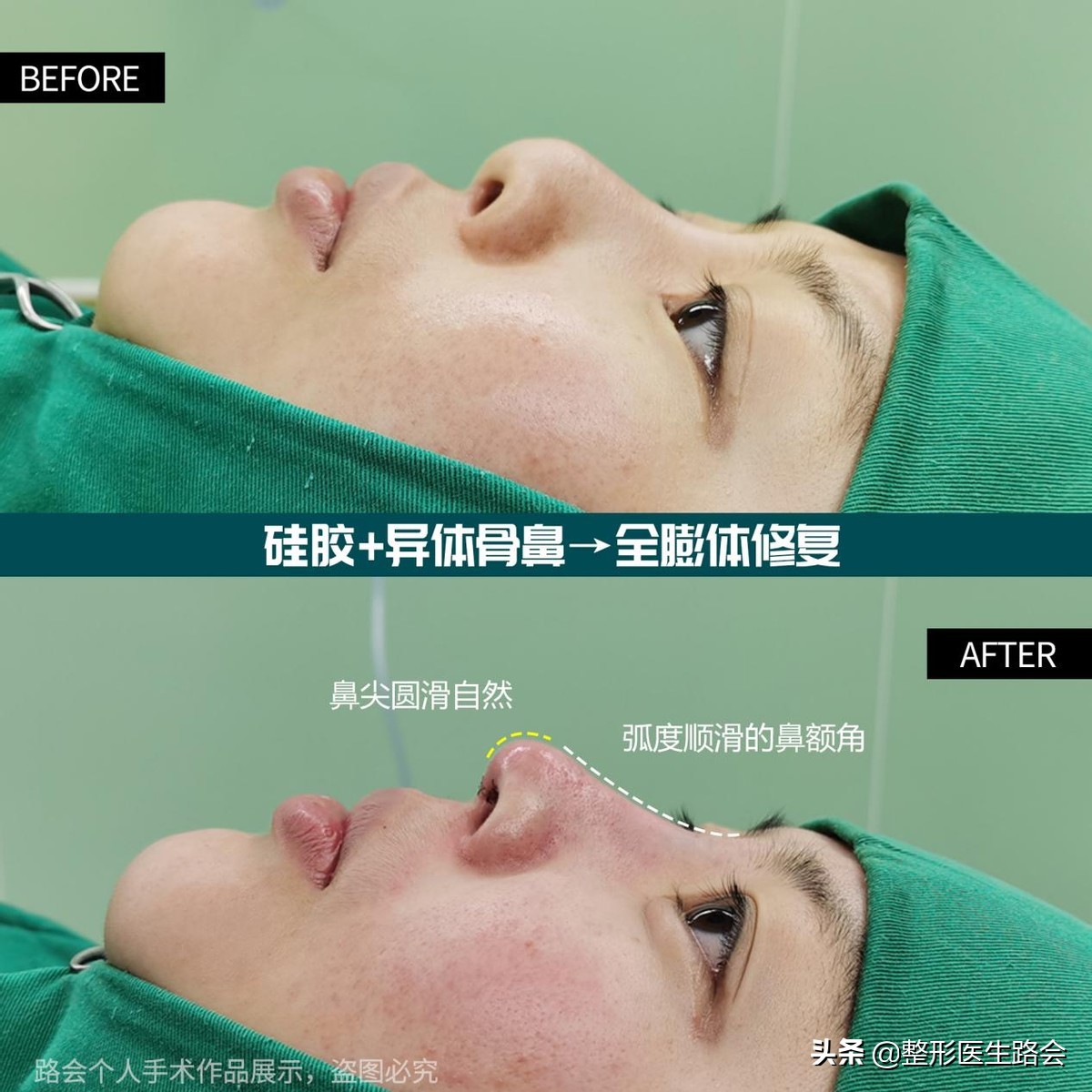 鼻子硅胶假体取出来真实感受,取出硅胶假体鼻子1-7天恢复过程图