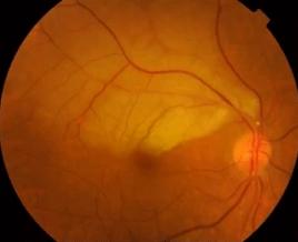 三甲医院整形医生才敢说的大实话,玻尿酸填充次数多了会有后遗症么