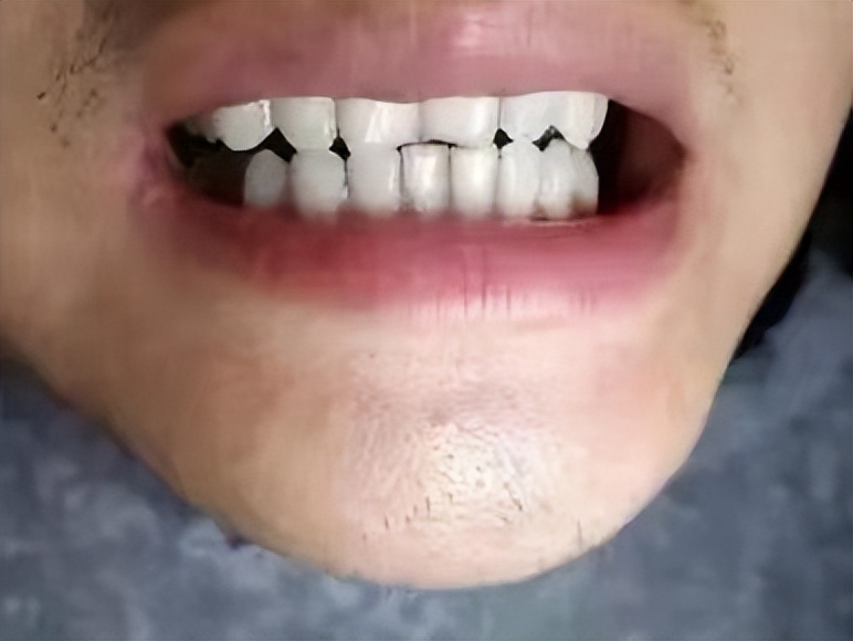 牙黄的克星一招搞定,牙黄小妙招立马见效