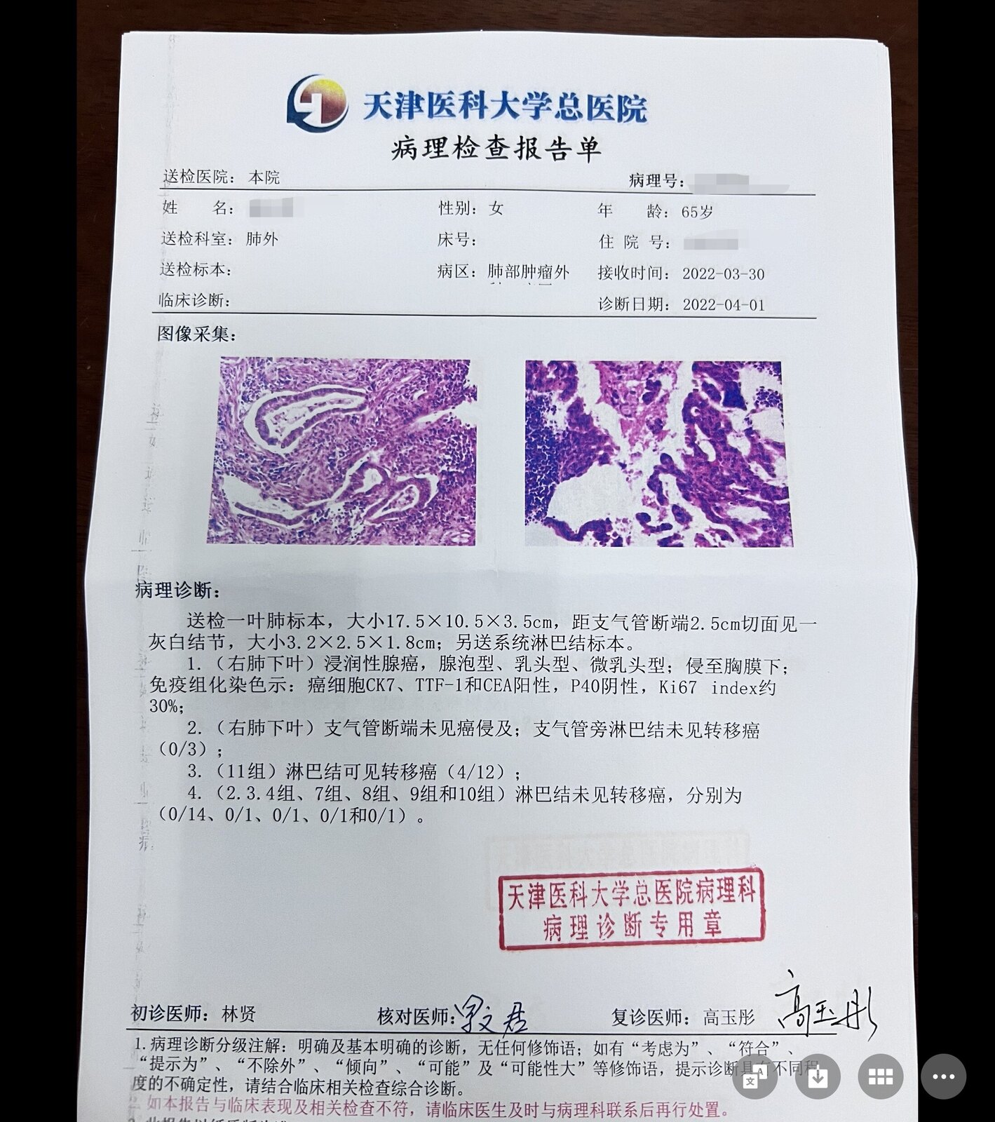 刘懿博士说肺癌,刘懿博士谈肺癌脑转移