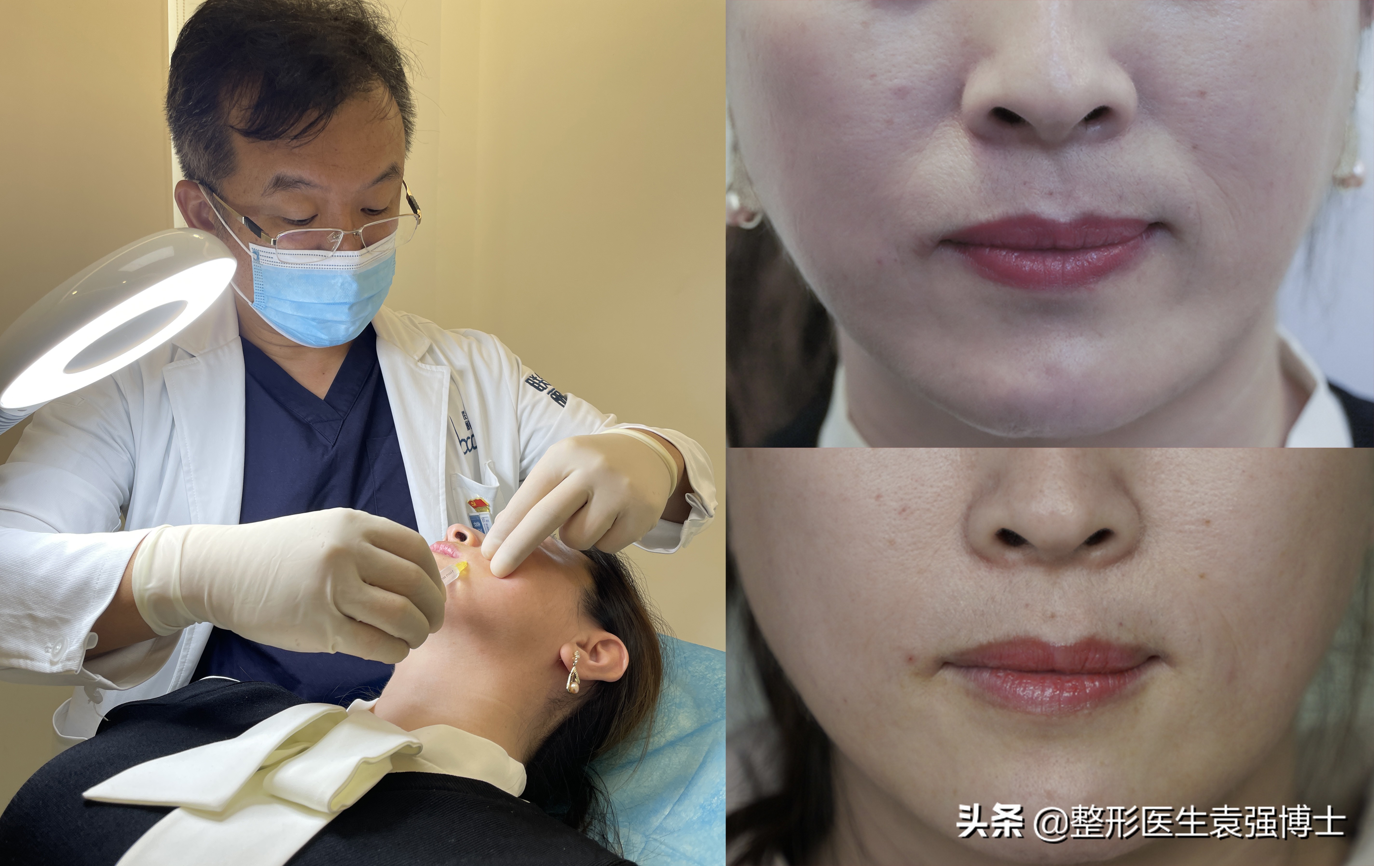 30多岁为什么法令纹那么严重,30岁左右法令纹严重怎么办