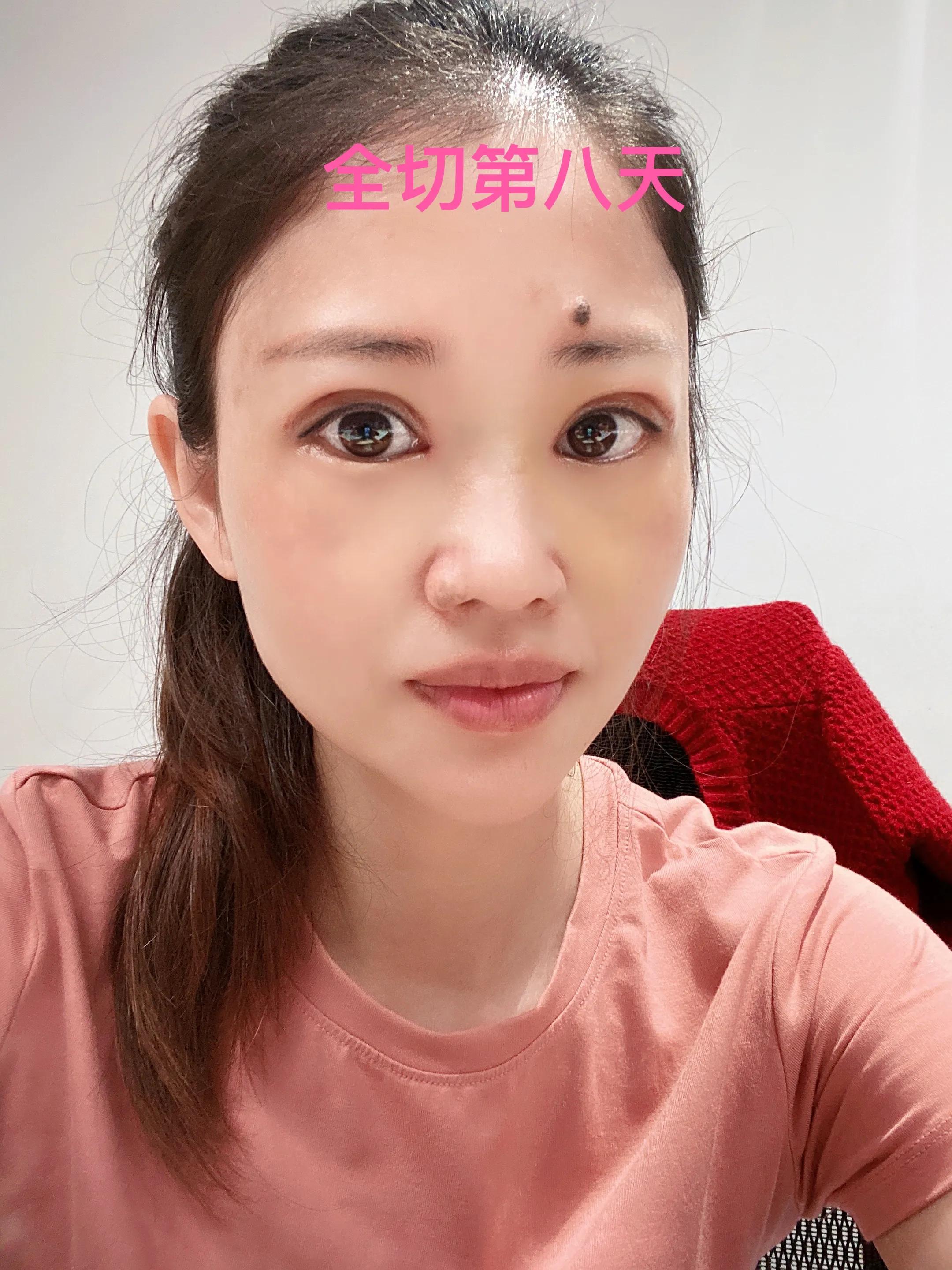 做双眼皮恢复期间能吃红糖吗,恢复最快的双眼皮