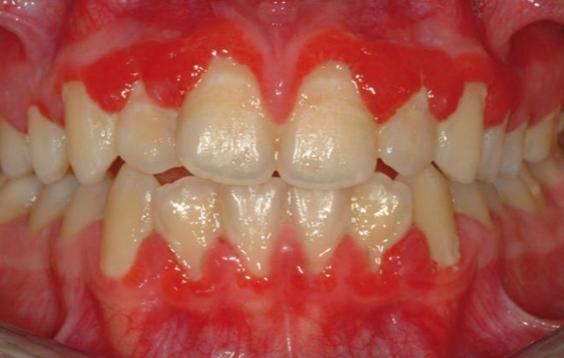 肝火胃火口舌生疮吃什么药,口舌生疮是有胃火肝火还是有肺火