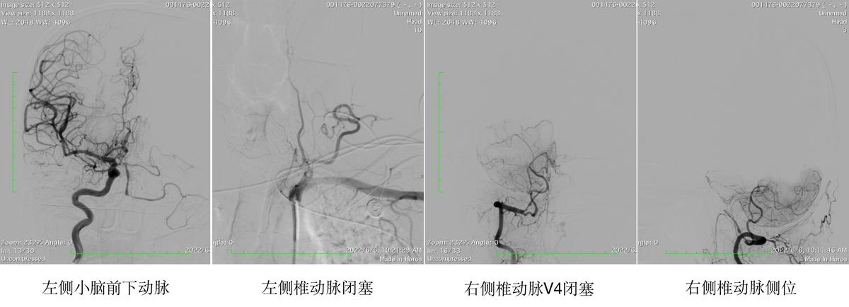 哈尔滨医大一医院脑动脉手术,哈医大一院脑神经外科