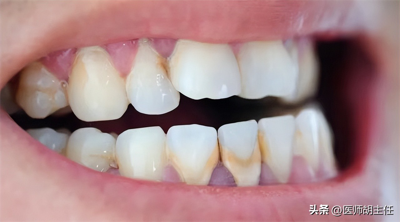 清理牙缝牙结石最有效方法,如何清除牙缝里的牙结石