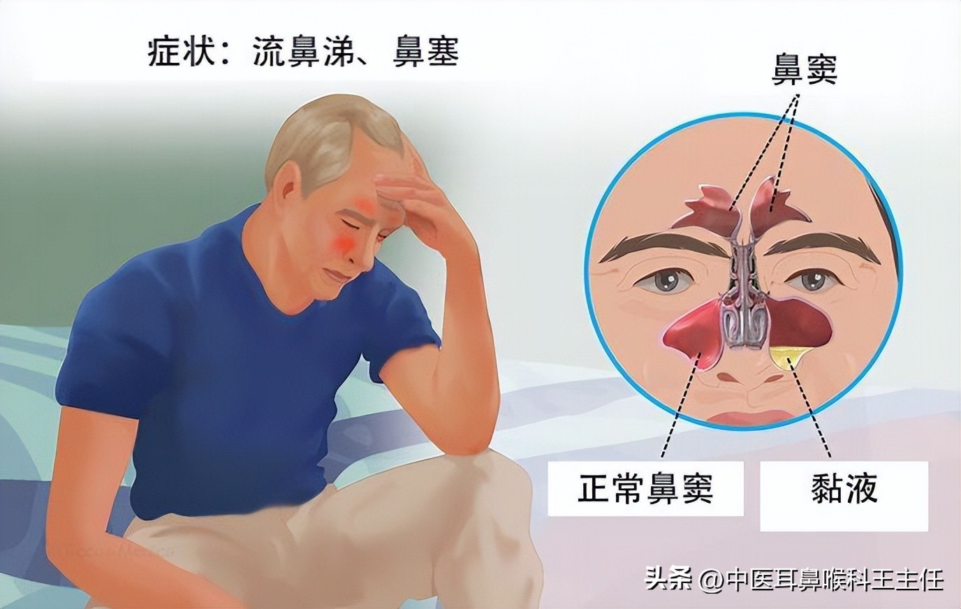 反复流鼻涕鼻塞怎么治疗,鼻窦炎一直流鼻涕如何缓解