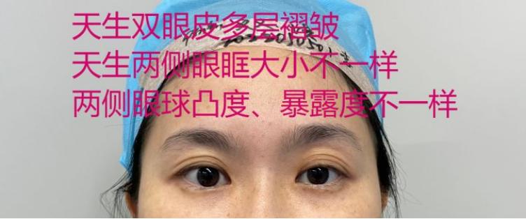 整形双眼皮失败案例,广州宝妈产后修复