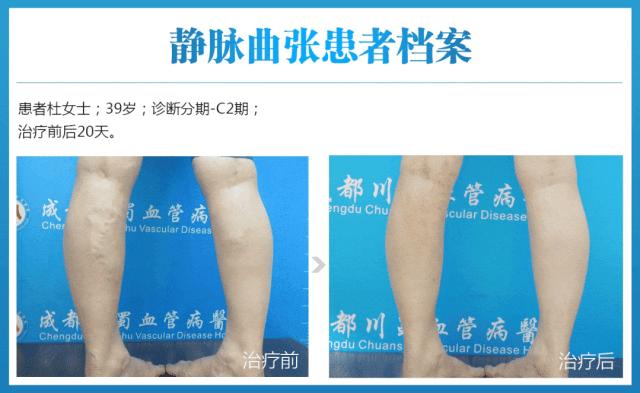 静脉曲张重要通知,静脉曲张优惠活动