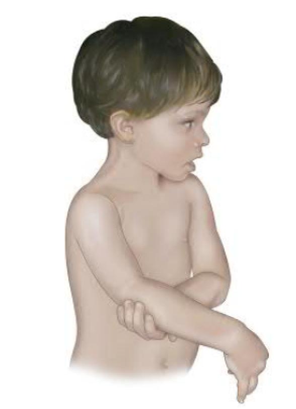 锁骨骨折吃什么食物最好,锁骨骨折怎么绑绷带视频