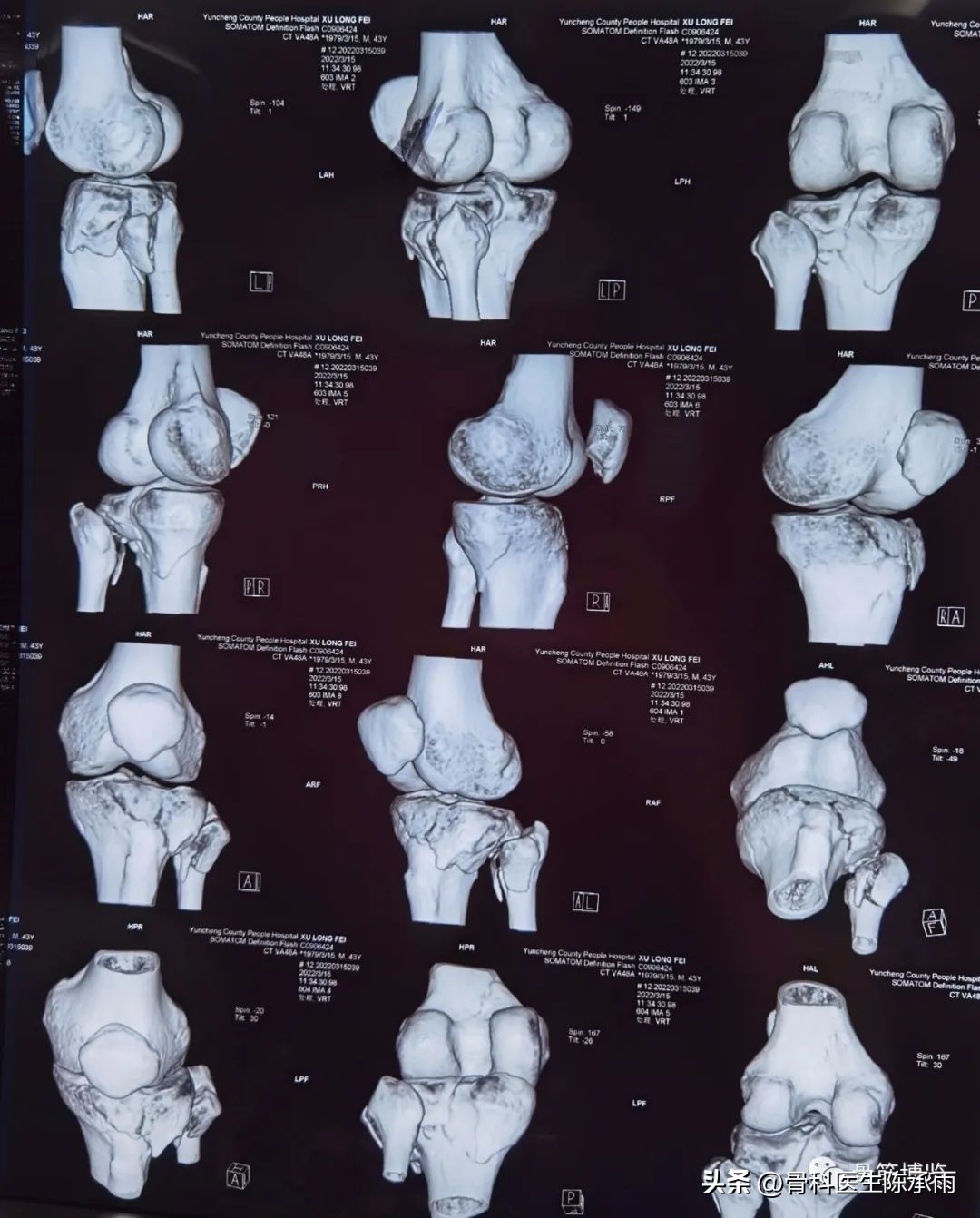 膝关节胫骨平台骨折,最近胫骨平台骨折视频