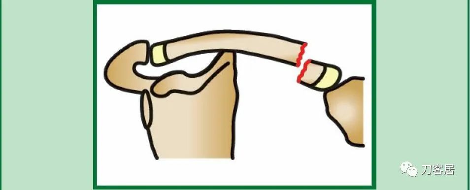 儿童锁骨骨折保守治疗的弊端,锁骨粉碎骨折错位不处理会愈合吗