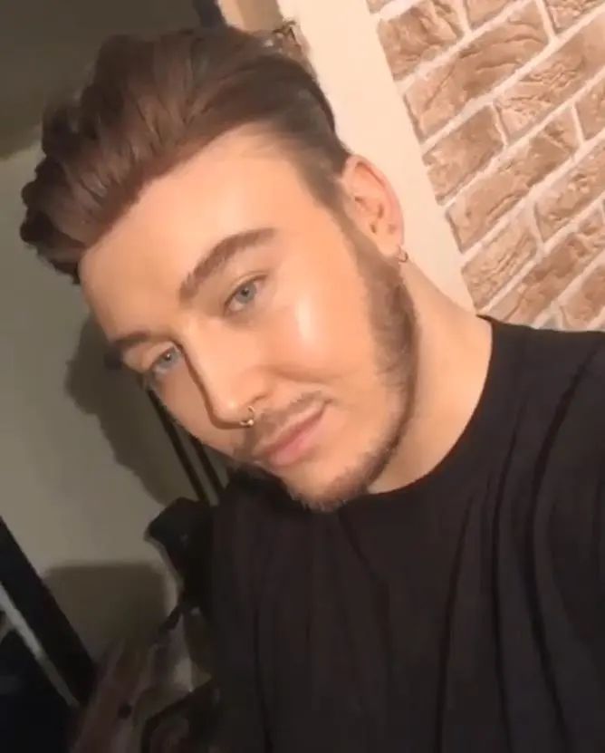 发际线后移遗传吗,发际线后移怎么办适合什么发型