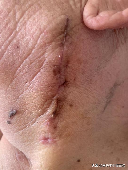 *安泰**市中医医院脑病外科成功开展一例高难度“颈动脉内膜剥脱术”