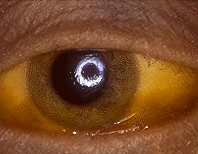 停药后乙肝病毒数升高,停药十年病毒量未升高