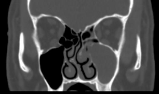 肉芽肿性血管炎ct表现,嗜酸性肉芽肿性血管炎症状