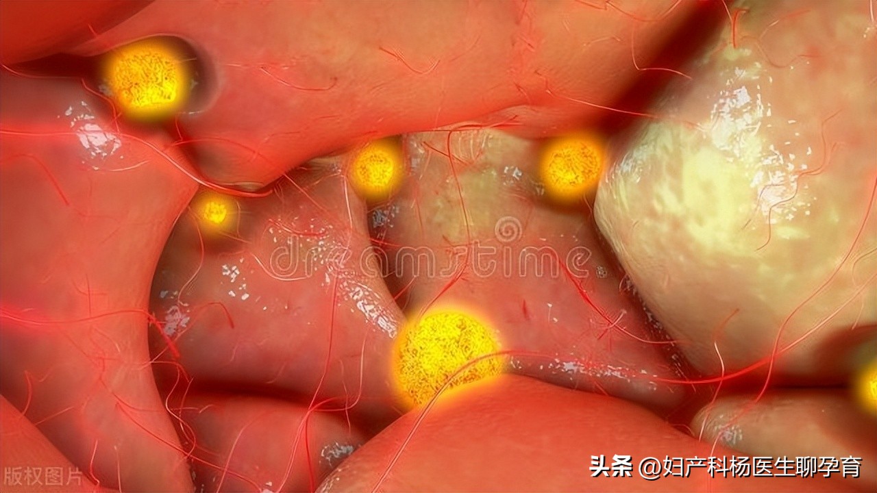 有卵巢囊肿又有多囊卵巢综合征,卵巢囊肿超声检查一般显示什么